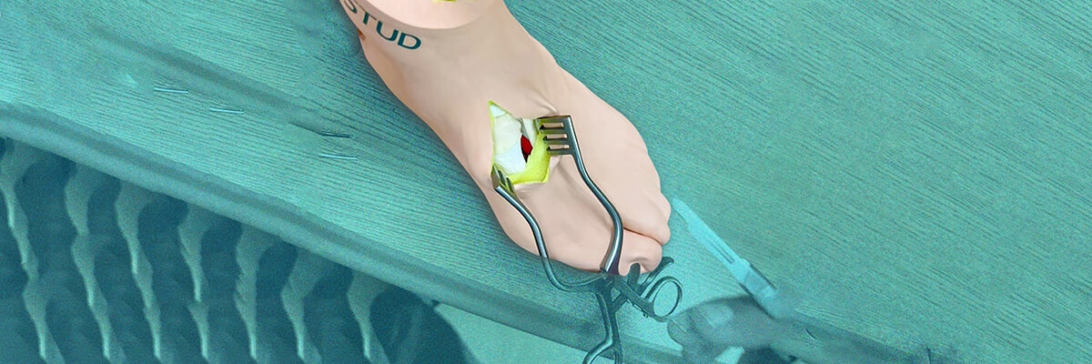 Saving Time and Money with Synthetic Bunion Surgical Model 